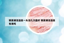 银屑病泡温泉一头泡几次最好 银屑病泡温泉有用吗