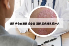 银屑病会有淋巴结全面 副银屑病淋巴结肿大
