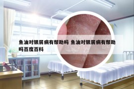 鱼油对银屑病有帮助吗 鱼油对银屑病有帮助吗百度百科
