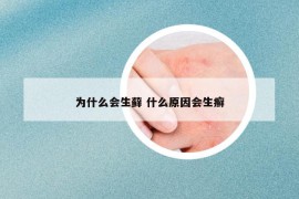 为什么会生藓 什么原因会生癣