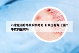 石家庄治疗牛皮癣的地方 石家庄有专门治疗牛皮的医院吗