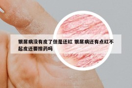 银屑病没有皮了但是还红 银屑病还有点红不起皮还要擦药吗