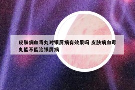 皮肤病血毒丸对银屑病有效果吗 皮肤病血毒丸能不能治银屑病