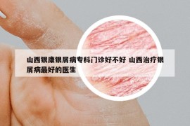 山西银康银屑病专科门诊好不好 山西治疗银屑病最好的医生