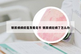 银屑病病症是发着走不 银屑病犯病了怎么办