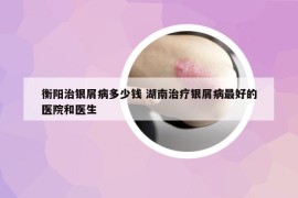 衡阳治银屑病多少钱 湖南治疗银屑病最好的医院和医生