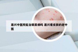 嘉兴中医院能治银屑病吗 嘉兴看皮肤的老中医