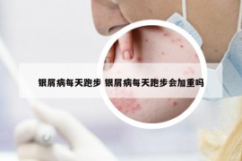 银屑病每天跑步 银屑病每天跑步会加重吗
