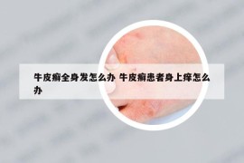 牛皮癣全身发怎么办 牛皮癣患者身上痒怎么办