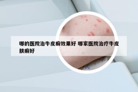 哪的医院治牛皮癣效果好 哪家医院治疗牛皮肤癣好