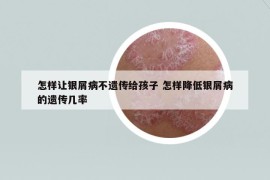 怎样让银屑病不遗传给孩子 怎样降低银屑病的遗传几率