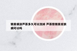 银屑病涂芦荟多久可以洗掉 芦荟擦银屑皮肤病可以吗