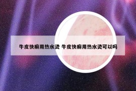 牛皮快癣用热水烫 牛皮快癣用热水烫可以吗