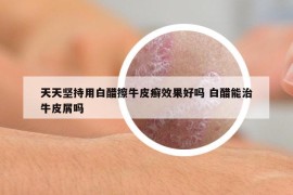 天天坚持用白醋擦牛皮癣效果好吗 白醋能治牛皮屑吗