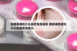 有银屑病吃什么能把免疫提高 银屑病患者吃什么能提高免疫力