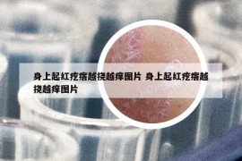 身上起红疙瘩越挠越痒图片 身上起红疙瘩越挠越痒图片