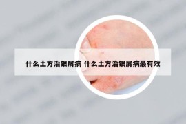 什么土方治银屑病 什么土方治银屑病最有效