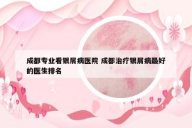 成都专业看银屑病医院 成都治疗银屑病最好的医生排名