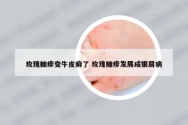 玫瑰糠疹变牛皮癣了 玫瑰糠疹发展成银屑病