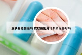 皮肤藓能根治吗 皮肤癣能用什么药治得好吗