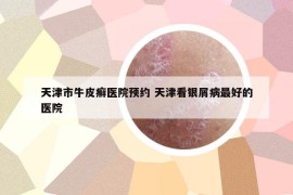 天津市牛皮癣医院预约 天津看银屑病最好的医院