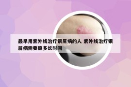 最早用紫外线治疗银屑病的人 紫外线治疗银屑病需要照多长时间