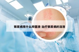 银屑病用什么抑菌液 治疗银屑病的溶液