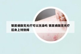 银屑病做完光疗可以洗澡吗 银屑病做完光疗后身上特别痒