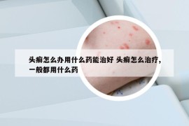 头癣怎么办用什么药能治好 头癣怎么治疗,一般都用什么药