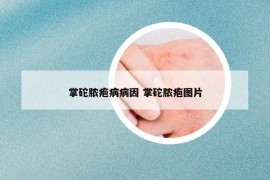 掌砣脓疱病病因 掌砣脓疱图片