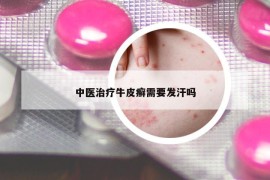中医治疗牛皮癣需要发汗吗