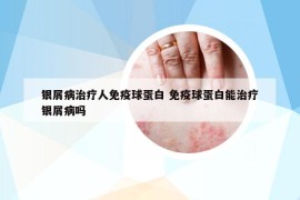 银屑病治疗人免疫球蛋白 免疫球蛋白能治疗银屑病吗