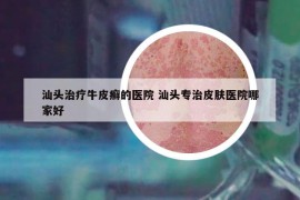 汕头治疗牛皮癣的医院 汕头专治皮肤医院哪家好