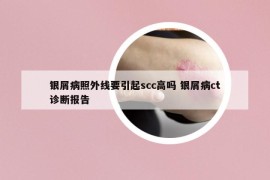 银屑病照外线要引起scc高吗 银屑病ct诊断报告