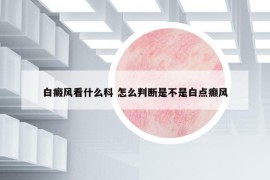 白癜风看什么科 怎么判断是不是白点癫风