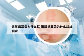 银屑病耳朵为什么红 银屑病耳朵为什么红红的呢