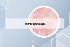 牛皮癣能穿冰袖吗