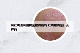 有红斑没有鳞屑是银屑病吗 红斑银屑是什么样的