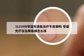 311UVB窄谱光波能治疗牛皮癣吗 窄谱光疗仪治银屑病怎么样