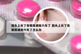 我头上长了有银屑病有六年了 我头上长了有银屑病有六年了怎么办