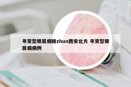 寻常型银屑病精zhun西安北方 寻常型银屑病病例