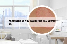 银屑病哺乳期光疗 哺乳期银屑病可以做光疗吗