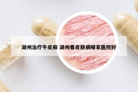 湖州治疗牛皮癣 湖州看皮肤病哪家医院好