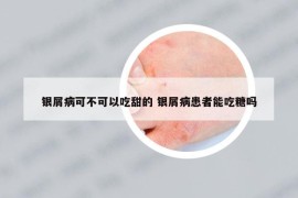 银屑病可不可以吃甜的 银屑病患者能吃糖吗