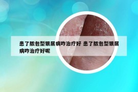 患了脓包型银屑病咋治疗好 患了脓包型银屑病咋治疗好呢