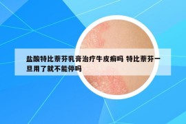 盐酸特比萘芬乳膏治疗牛皮癣吗 特比萘芬一旦用了就不能停吗
