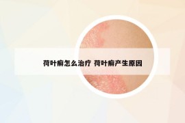 荷叶癣怎么治疗 荷叶癣产生原因