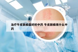 治疗牛皮肤癣最好的中药 牛皮肤癣用什么中药