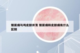 银屑病与鸡皮肤并发 银屑病和皮肤病有什么区别