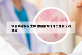 银屑病涂抹凡士林 银屑病涂抹凡士林和卡泊三醇
